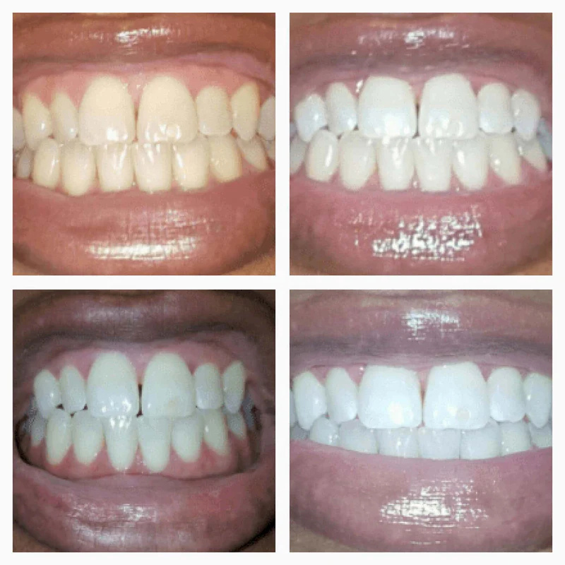 SMILUX™ / Stylo Blanchissant Express